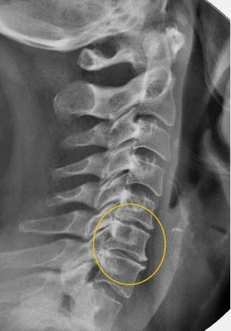 Osteochondrosis krční páteře na x -radě